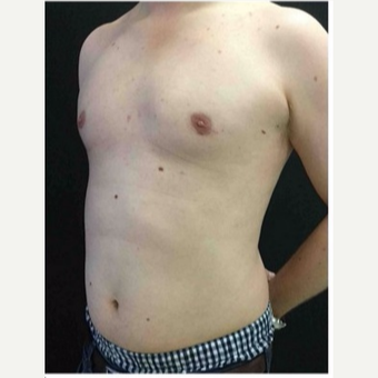 25-34 year old man treated with Male Breast Reduction after 3218522