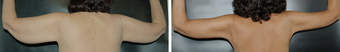 Arm Lift before 1149419