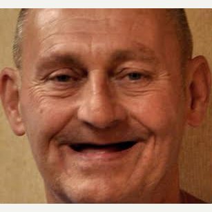 55-64 year old man treated with All-on-4 Dental Implants before 3724066