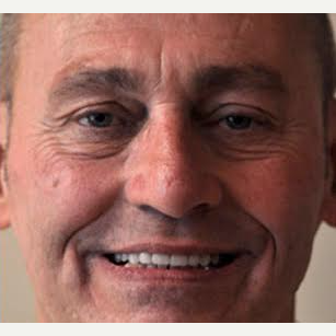 55-64 year old man treated with All-on-4 Dental Implants after 3724066