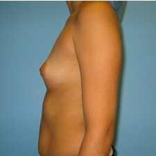 Breast Augmentation before 3665694