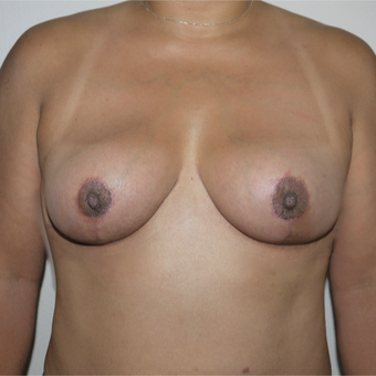45-54 year old woman treated with Breast Implant Removal after 3077639