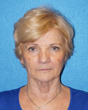67 year old woman treated with Facelift 3576596