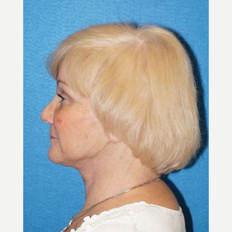 67 year old woman treated with Facelift after 3576596