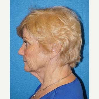 67 year old woman treated with Facelift before 3576596