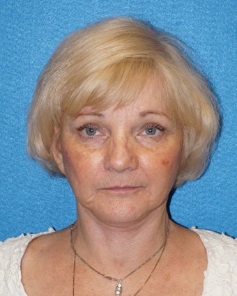 67 year old woman treated with Facelift 3576596