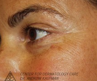 Mohs Surgery of Basal Cell Carcinoma and Recontruction after 315051