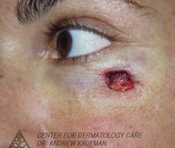 Mohs Surgery of Basal Cell Carcinoma and Recontruction before 315051