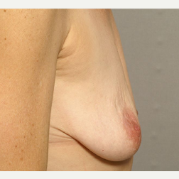 45-54 year old woman treated with Breast Augmentation before 3072433