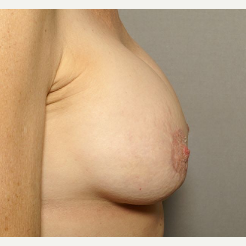 45-54 year old woman treated with Breast Augmentation after 3072433