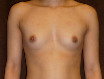 Breast Augmentation before 587788