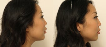 Non-surgical Asian Rhinoplasty before 1181365