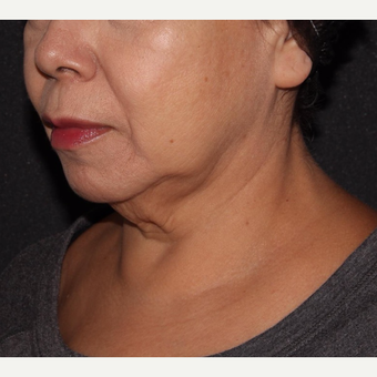 55-64 year old woman treated with Coolmini and Ultherapy before 3669741