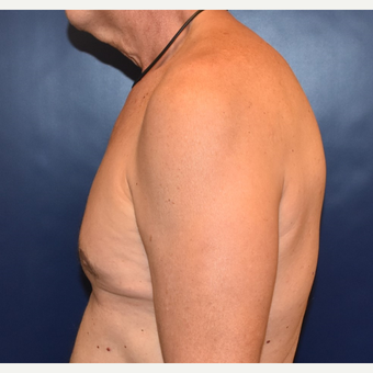 55-64 year old woman treated with Male Breast Reduction after 3384890