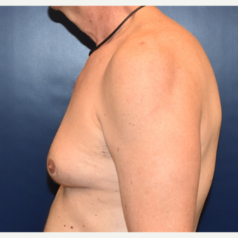55-64 year old woman treated with Male Breast Reduction before 3384890