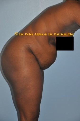 37 year old woman treated with Full Tummy Tuck before 2680107