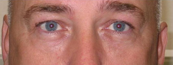 Under Eye Bags after 1460215
