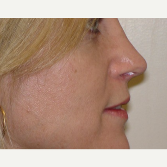 35-44 year old woman treated with Rhinoplasty after 3370781
