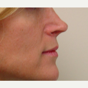 35-44 year old woman treated with Rhinoplasty before 3370781