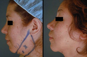 Chin / Neck Liposuction before 996362