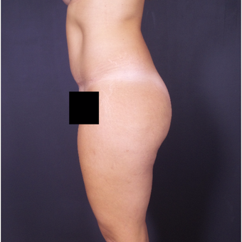 25-34 year old woman treated with Tummy Tuck after 3150027