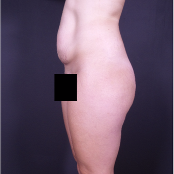 25-34 year old woman treated with Tummy Tuck before 3150027