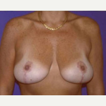 45-54 year old woman treated with Breast Lift after 3423765