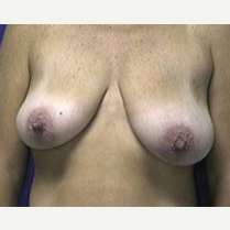 45-54 year old woman treated with Breast Lift before 3423765