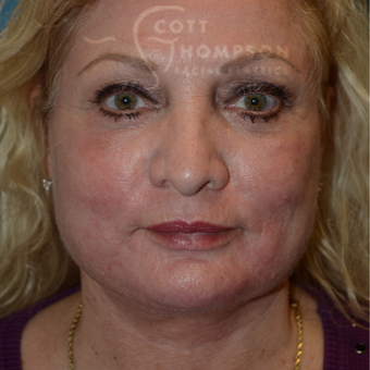 55-64 year old woman treated with Facelift after 3245809