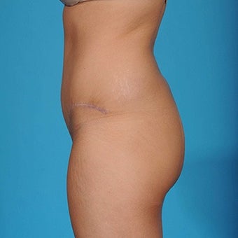 25 year old woman treated with Tummy Tuck after 1792955