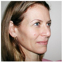 Upper eyelid blepharoplasty / lower eyelid Restylane injection / endoscopic brow lift. before 334407