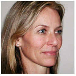 Upper eyelid blepharoplasty / lower eyelid Restylane injection / endoscopic brow lift. after 334407