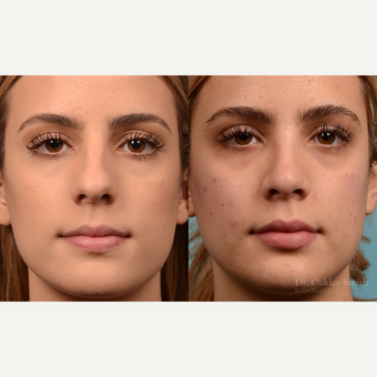 25-34 year old woman treated with Revision Rhinoplasty before 3821369