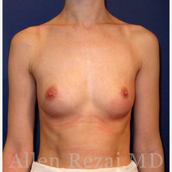 Bilateral Breast Augmentation - Pre- & 9 Months Post-op before 3473968