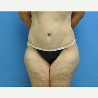 40 year old woman treated with Tummy Tuck after 2956401