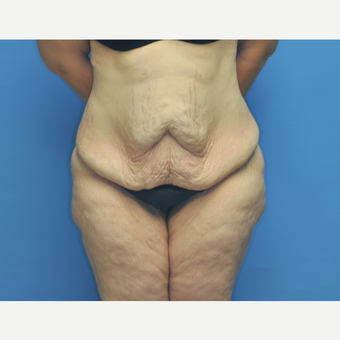 40 year old woman treated with Tummy Tuck before 2956401