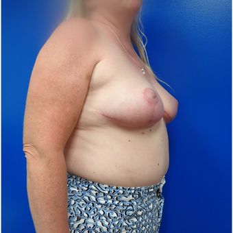 55-64 year old woman treated with Breast Reduction after 3330884