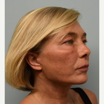 45-54 year old woman treated with Mini Lift after 3428313