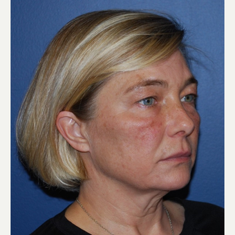 45-54 year old woman treated with Mini Lift before 3428313