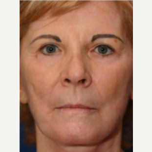 65-74 year old woman treated with Chemical Peel after 3646116