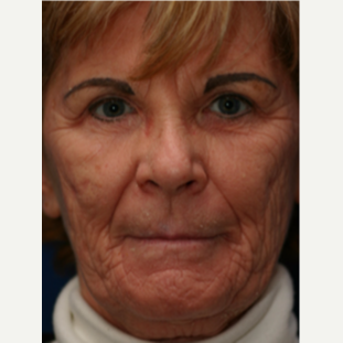 65-74 year old woman treated with Chemical Peel before 3646116
