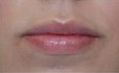 Restylane Injections for Lip Augmentation after 53752
