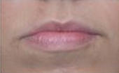 Restylane Injections for Lip Augmentation before 53752