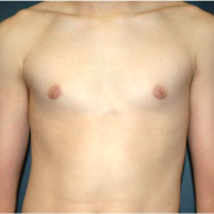 15 year old man treated with Male Breast Reduction after 3720929