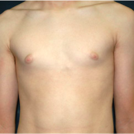 15 year old man treated with Male Breast Reduction before 3720929