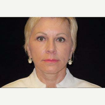65-74 year old woman treated with Facelift and quad blepharoplasty, Fractionated Co2 Laser after 2509024