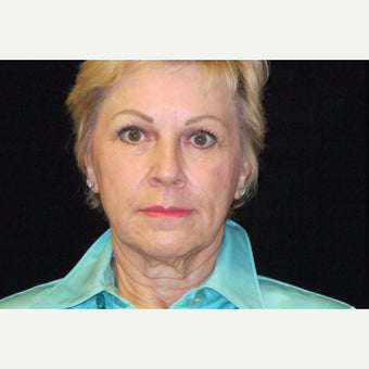 65-74 year old woman treated with Facelift and quad blepharoplasty, Fractionated Co2 Laser before 2509024