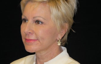 65-74 year old woman treated with Facelift and quad blepharoplasty, Fractionated Co2 Laser 2509024