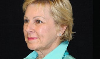 65-74 year old woman treated with Facelift and quad blepharoplasty, Fractionated Co2 Laser 2509024