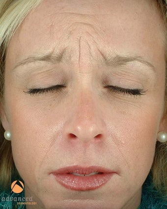 Female Patient Treated with BOTOX® Cosmetic before 1047033